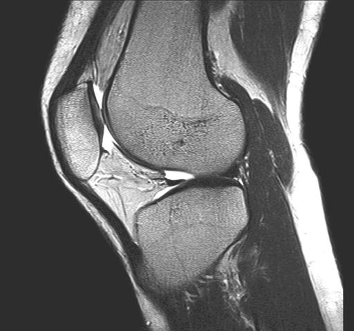 MRT Bild eines Kniegelenks in seitlicher Ansicht MRT Bild eines Kniegelenks in seitlicher Ansicht