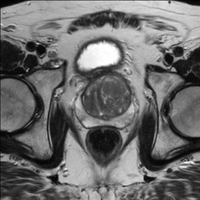 mpMRT der Prostata T2