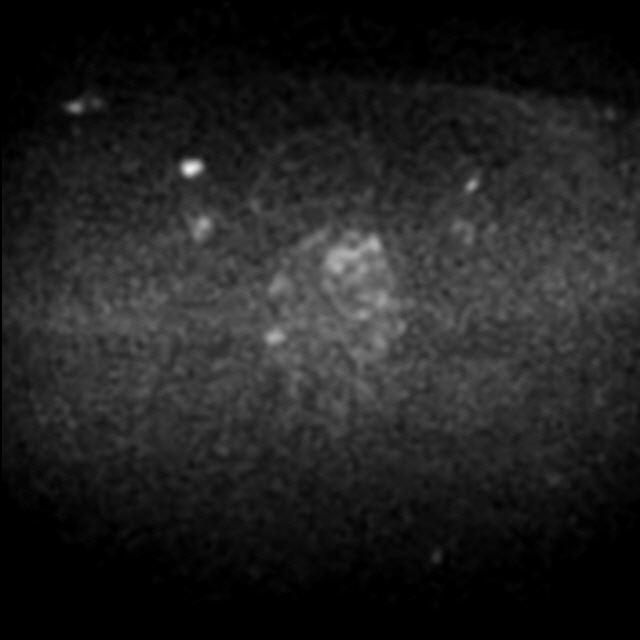 mpMRT der Prostata DWI