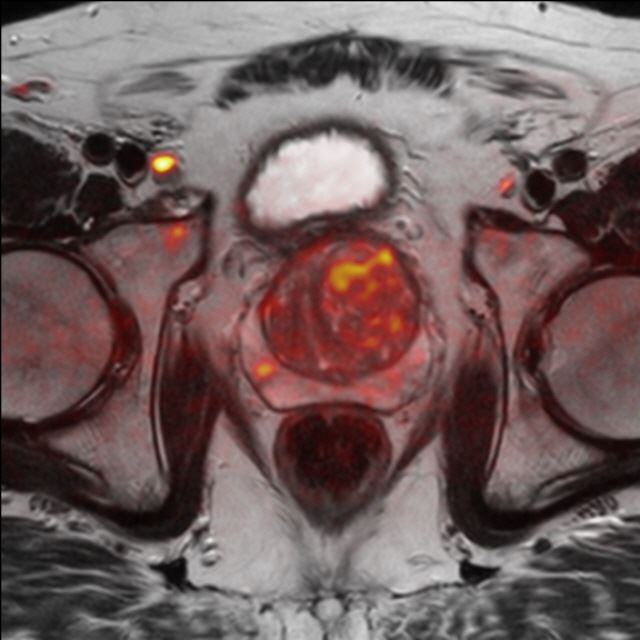 mpMRT der Prostata T2-DWI Overlay