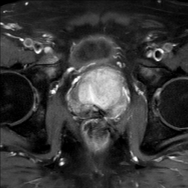 mpMRT der Prostata DCE fatsat