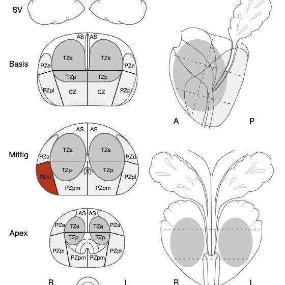 mpMRT der Prostata PIRADS Auswertung